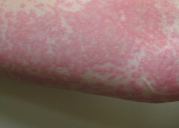 Biduran Sering Tanda Penyakit Apa Penyebab Penanganan dan Kapan Harus ke Dokter