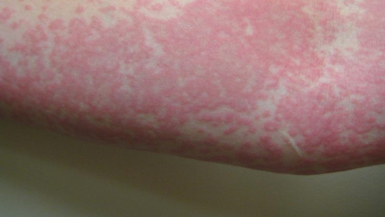 Biduran Sering Tanda Penyakit Apa Penyebab Penanganan dan Kapan Harus ke Dokter