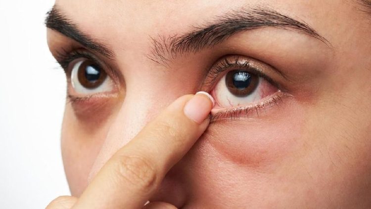 Gejala Penyakit Ginjal yang Muncul di Mata dan Penjelasannya