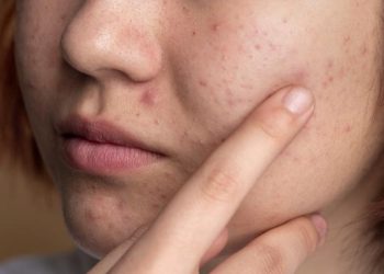 4 Jenis Jerawat Sulit Hilang dan Solusinya Tanpa Memperparah Kulit